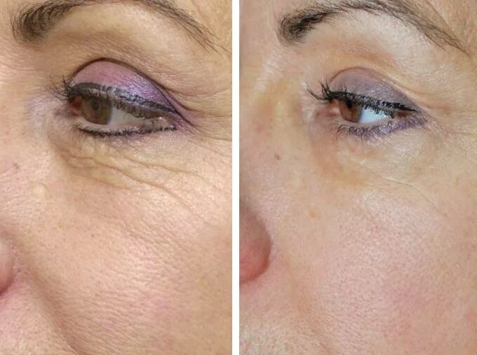 Lauko lazeris prieš ir po