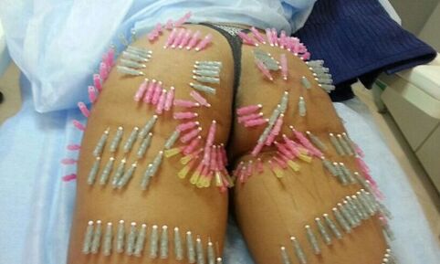 užpakalio pakėlimas